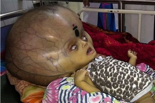 Mắc bệnh lạ, em bé có đầu to bất thường như "người ngoài hành tinh"  - Ảnh 2