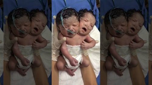 Video: Em bé 2 đầu mới chào đời tại Mexico - Ảnh 1