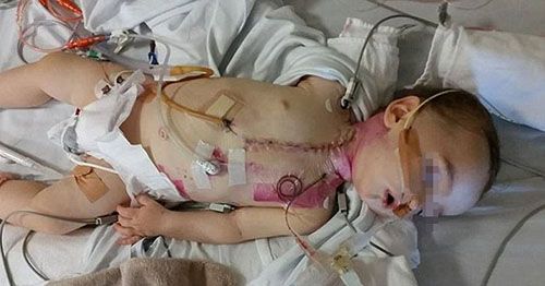 Cảnh báo: Bé gái 3 tuổi chịu đau đớn khi mắc pin khuy trong mũi - Ảnh 2