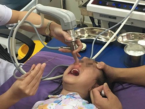 Cảnh báo: Bé gái 3 tuổi chịu đau đớn khi mắc pin khuy trong mũi - Ảnh 1