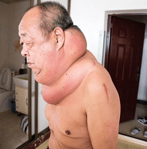 Người đàn ông 13 năm sống trong 'địa ngục' vì khối u khổng lồ trên cổ - Ảnh 1