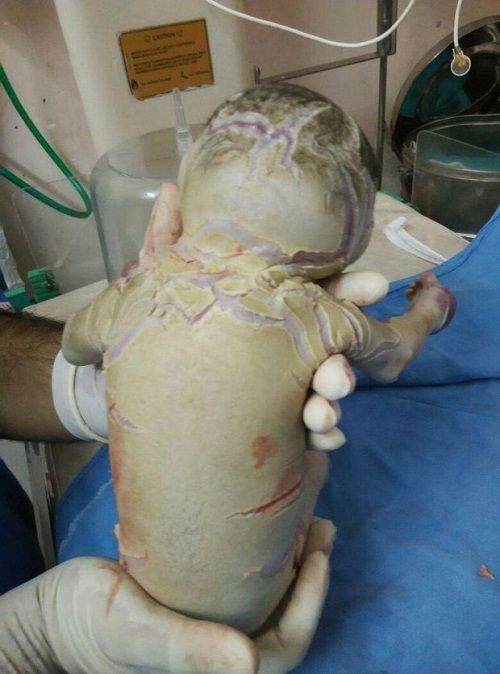 Mắc bệnh hiếm, bé sơ sinh bao phủ trong lớp vỏ dày kỳ lạ - Ảnh 2
