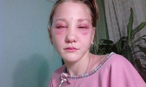 Đang tuổi thanh xuân cô gái có nguy cơ bị mù vĩnh viễn vì lý do rất nhiều người mắc phải - Ảnh 1