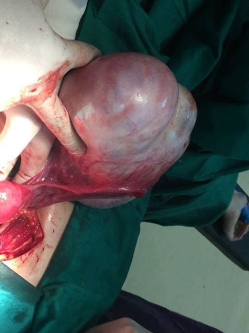 Khối u gần 2 kg ở buồng trứng nữ bệnh nhân 20 tuổi - Ảnh 1