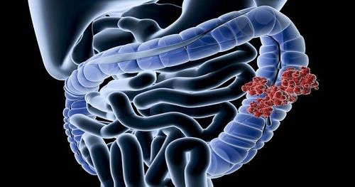Bệnh Crohn và nguy cơ ung thư - Ảnh 1