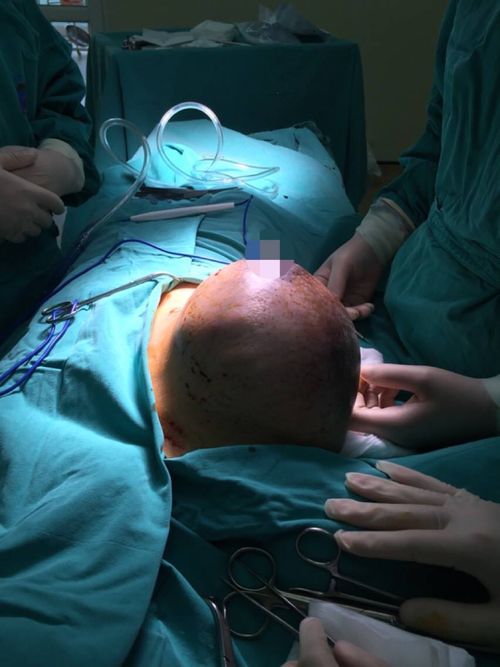 Sau sinh 2 ngày, sản phụ được phẫu thuật cắt khối u khổng lồ trên ngực phải - Ảnh 1