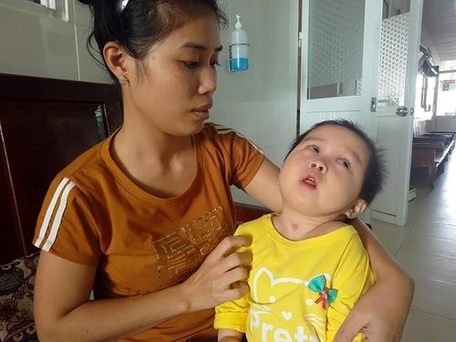 Xót thương bé gái 16 tháng tuổi teo não, mất nhận thức, tay chân co quắp chỉ vì côn trùng cắn - Ảnh 1