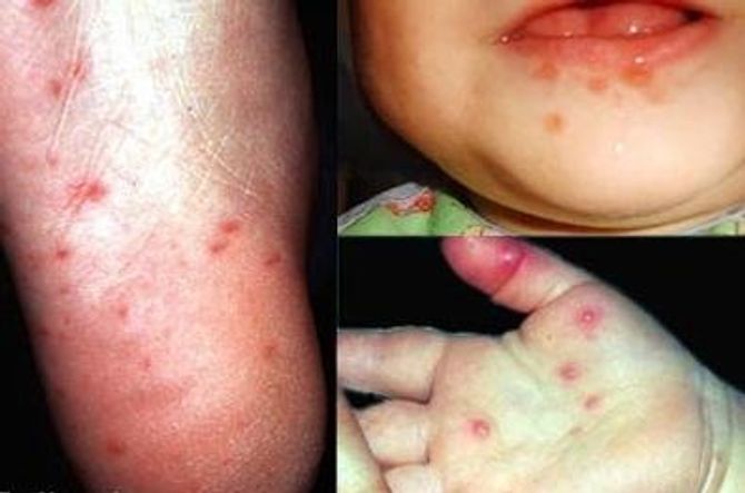 Triệu chứng và cách phòng chữa bệnh tay chân miệng ở trẻ em - Ảnh 1
