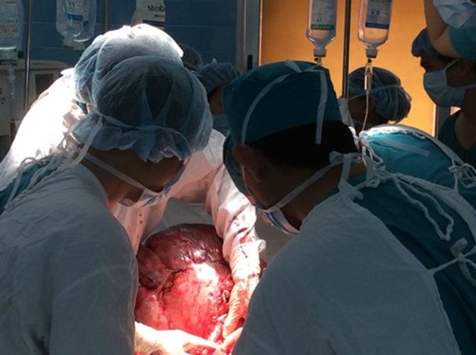 Phẫu thuật thành công khối u "khủng" nặng 26kg - Ảnh 1