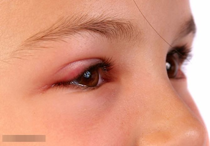 Cách chữa lẹo mắt cho bà bầu nhanh nhất – 24H