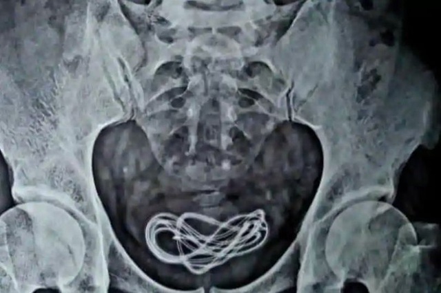 Bệnh nhân khai trót ăn dây sạc điện thoại, nhưng bác sĩ lại tìm thấy trong bàng quang - Ảnh 1