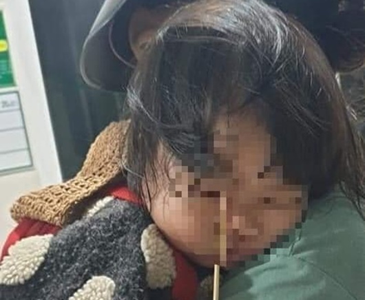 Gia Lai: Bé gái 3 tuổi bị que kem đâm vào hốc mắt vì vừa ăn vừa chạy nhảy - Ảnh 1