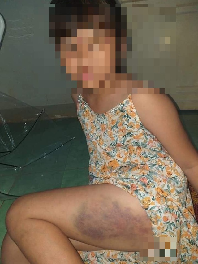 Vụ cô giáo đánh học sinh lớp 3 bầm tím đùi ở Đắk Lắk: Tạm đình chỉ 3 tháng - Ảnh 2