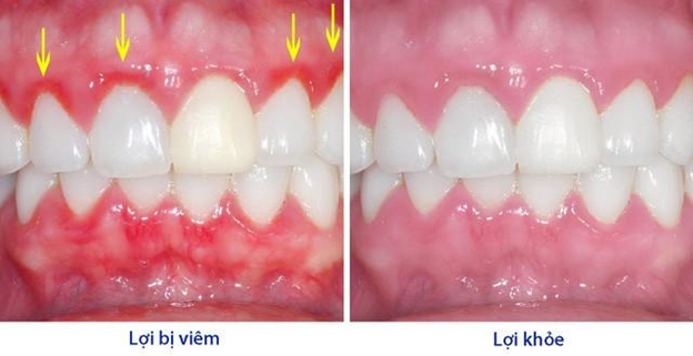 Top 5 bệnh lý răng miệng nguy hiểm mà người Việt Nam nào cũng mắc phải một lần trong đời - Ảnh 3