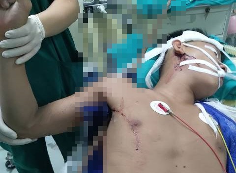 Phẫu thuật thành công cho nam thanh niên bị thanh sắt đâm từ nách lên vai - Ảnh 1