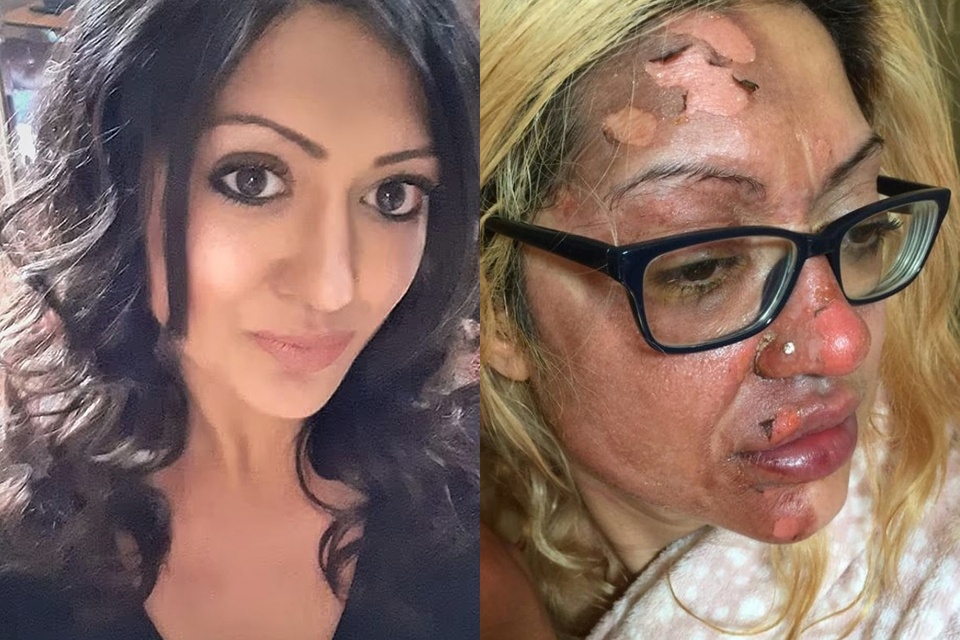 Cộng đồng mạng - Người phụ nữ bị bỏng nặng ở mặt chỉ vì bắt chước theo trend Tik Tok