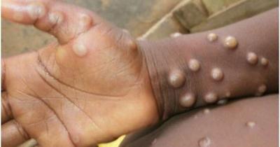 Sức khoẻ - Làm đẹp - Đồng Nai: Ghi nhận một ca bệnh dương tính với virus đậu mùa khỉ