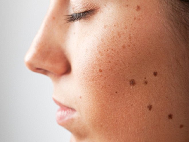 Sức khoẻ - Làm đẹp - Xóa nhiều nốt ruồi cùng một lúc ảnh hưởng đến da như thế nào? (Hình 2).