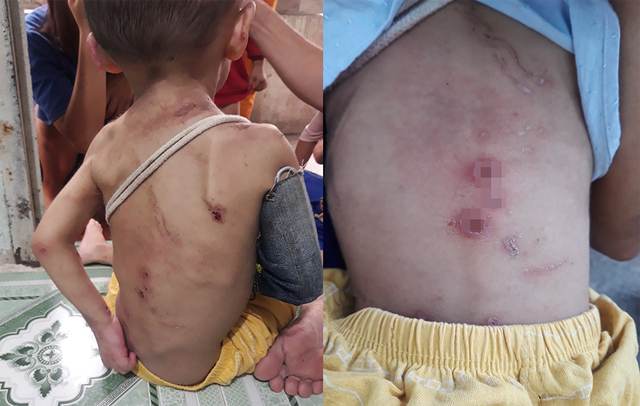 Tin trong nước - Sức khỏe bé 2 tuổi nghi bạo hành tại Hóc Môn hiện ra sao?