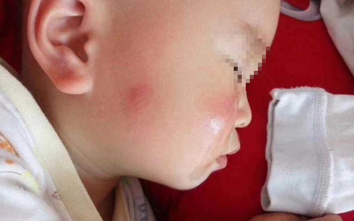 Sức khoẻ - Làm đẹp - Bà nội chữa muỗi đốt theo cách lạ, cháu trai phải nhập viện cấp cứu gấp