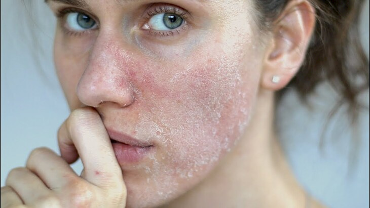 Sức khoẻ - Làm đẹp - Dấu hiệu nhận biết da mất nước và cách cấp ẩm tức thì cho làn da