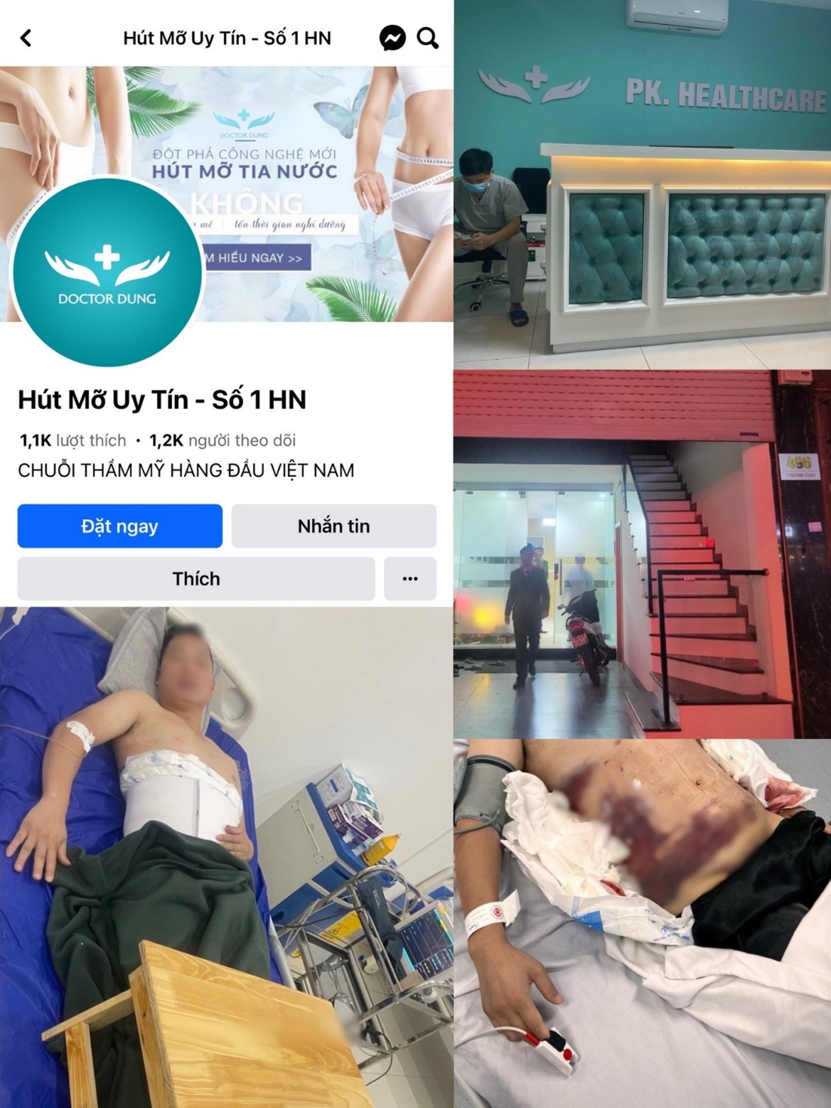 Xã hội - Hà Nội: Người đàn ông nhập viện trong tình trạng nguy kịch do hút mỡ bụng tại một cơ sở không phép