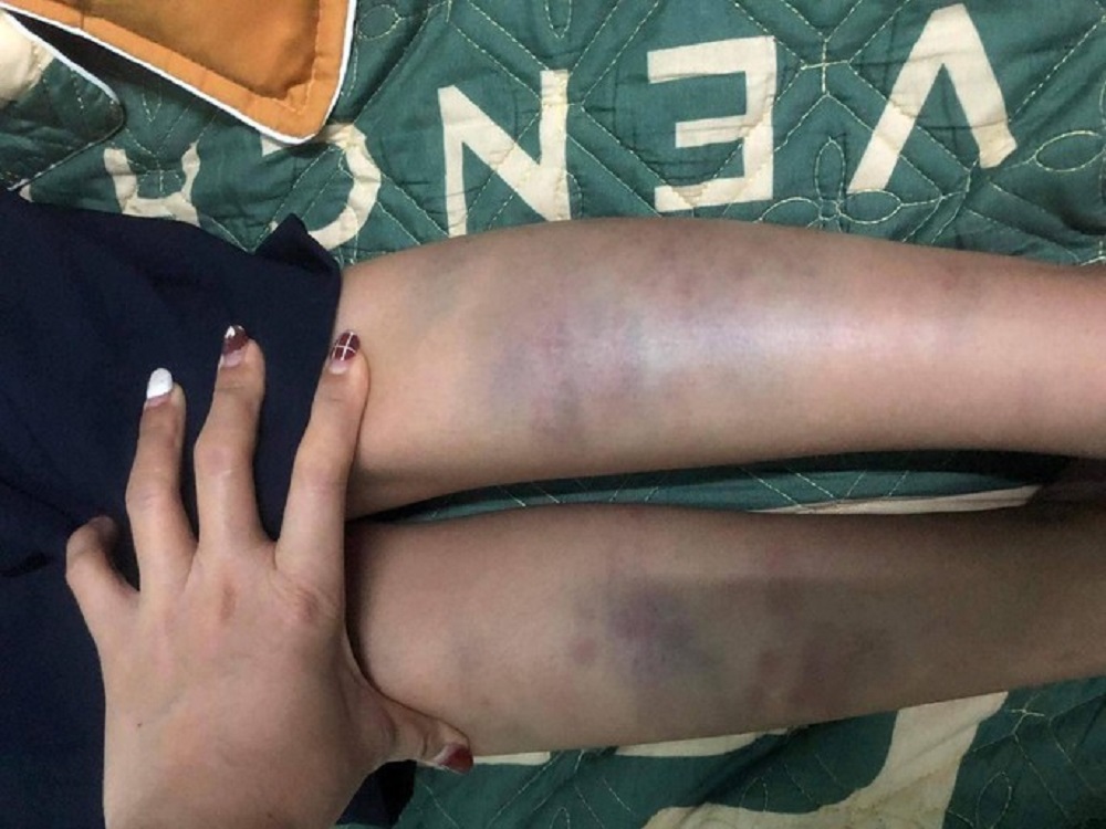 Giáo dục pháp luật - Vụ học sinh lớp 1 bị đánh bầm tím tay chân ở Đà Nẵng: Không khởi tố hình sự