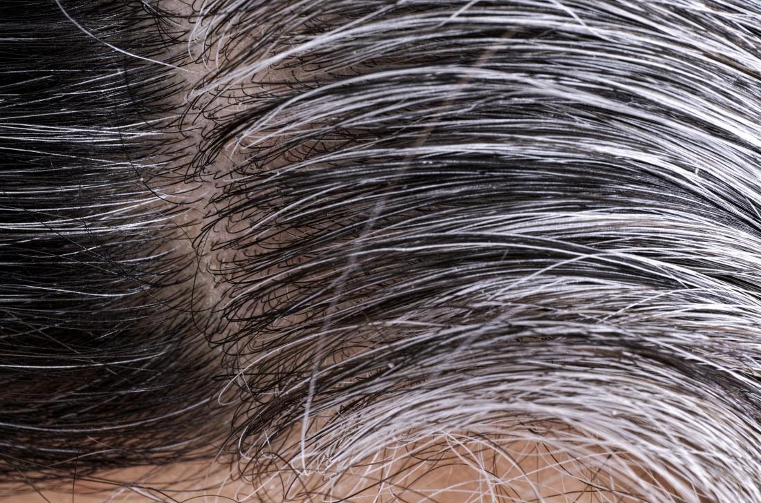 white and gray hairs growing on person s head