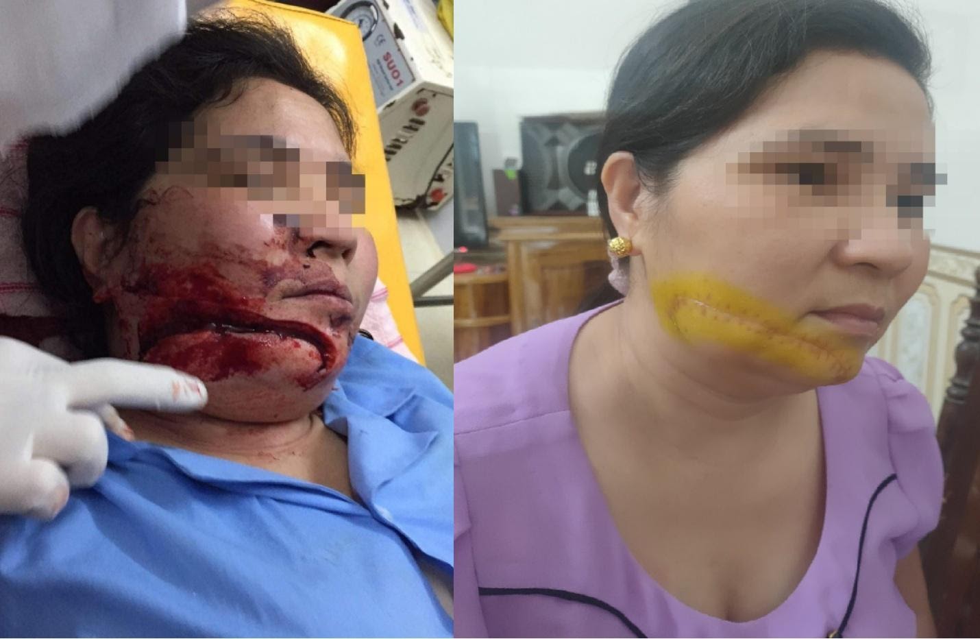 Xã hội - Hàm Yên, Tuyên Quang: Cần làm rõ hành vi kẻ chém người phụ nữ gây thương tích nghiêm trọng, nhưng vẫn nhởn nhơ ngoài vòng pháp luật