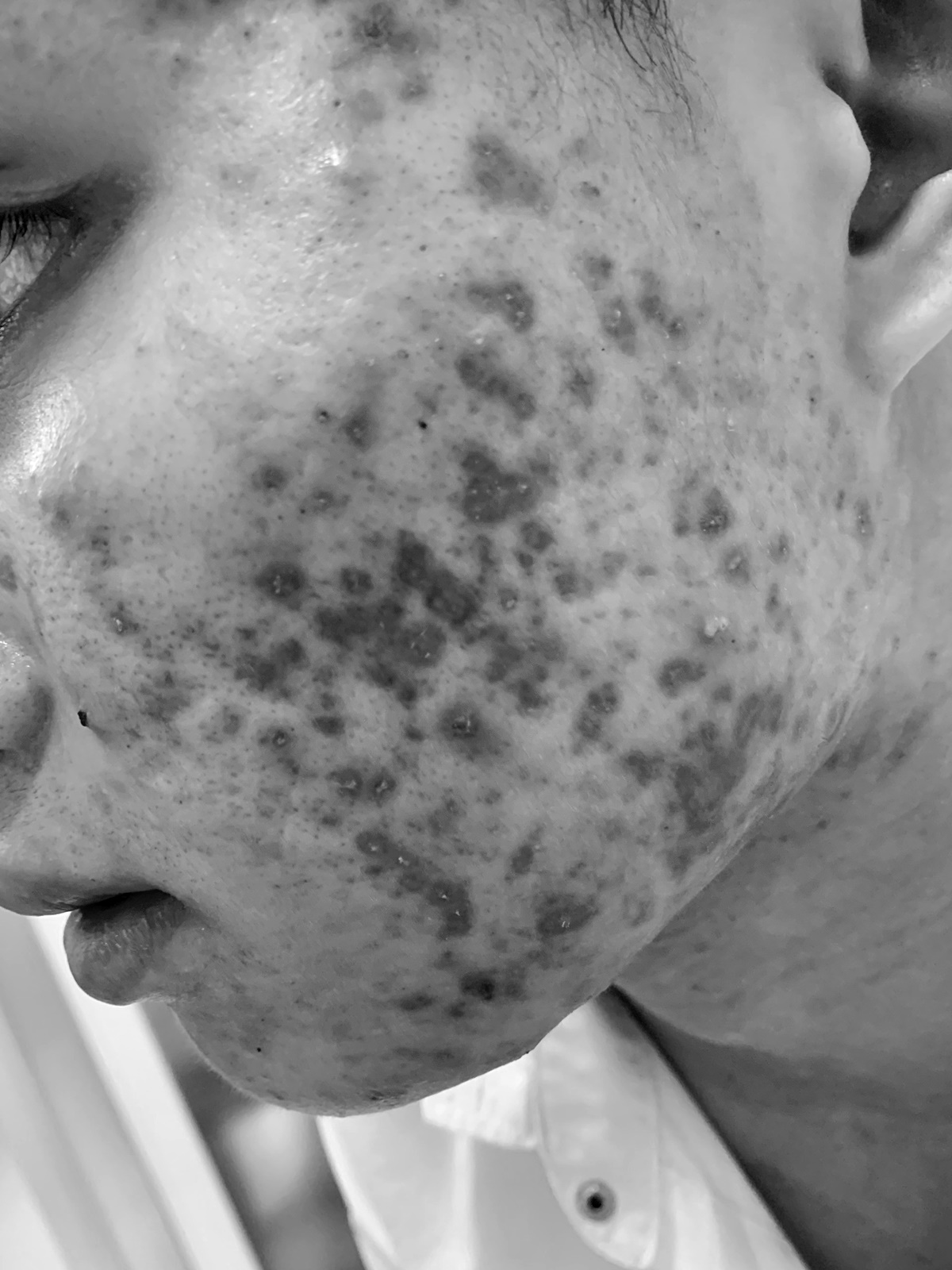 Sức khoẻ - Làm đẹp - Người đàn ông 30 triệu đồng trị sẹo rỗ nhưng da mặt xấu hơn, lúc đòi tiền nhận câu phũ phàng