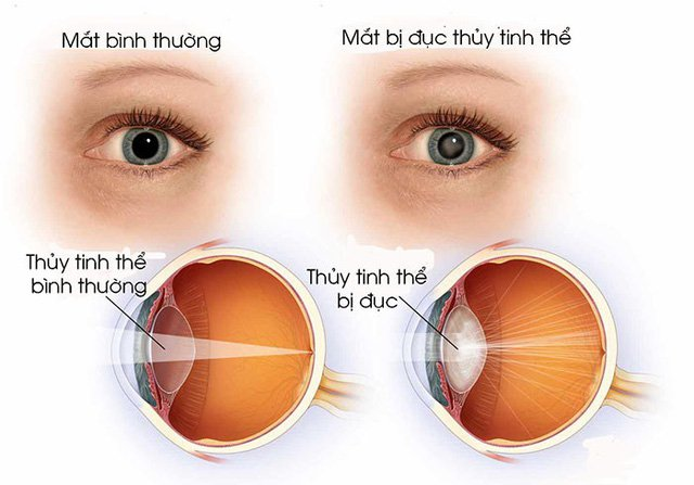 Cần biết - Hành trình trẻ hóa đôi mắt tại Trung Tâm Mắt Quốc Tế Vin Eye 