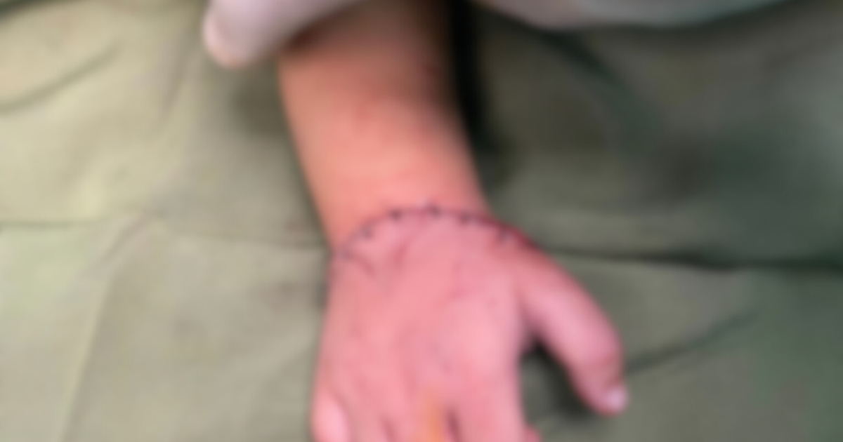 Sức khoẻ - Làm đẹp - Em bé 18 tháng tuổi được nối liền bàn tay sau tai nạn từ máy cắt đá của gia đình