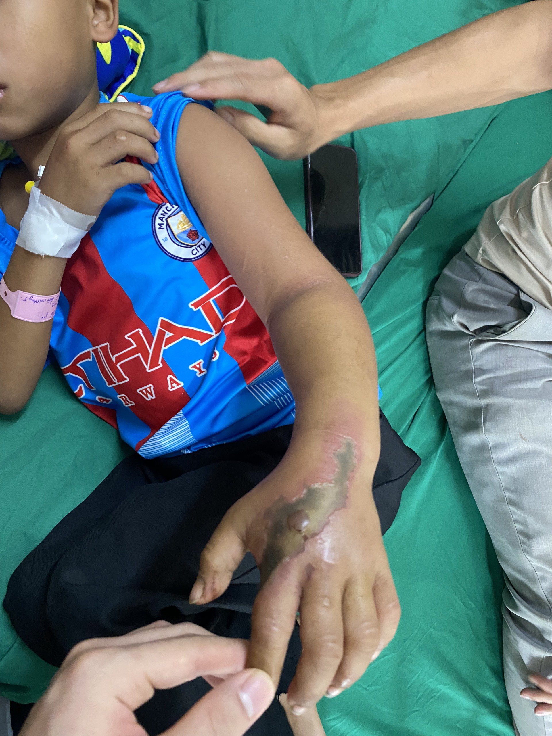 Sức khoẻ - Làm đẹp - Điều trị bàn tay bị hoại tử nghi do rắn cắn cho bé trai 8 tuổi