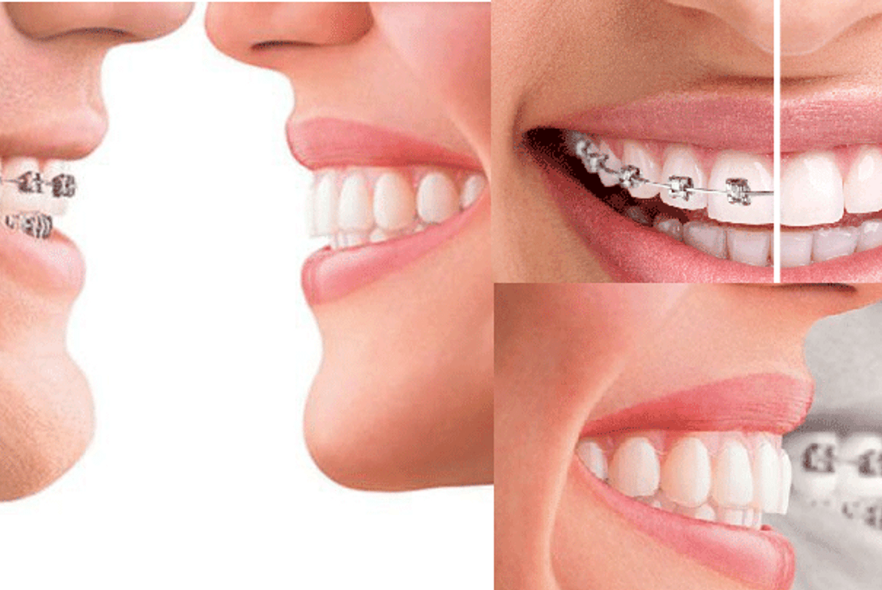 Răng thưa phải làm sao: Niềng răng hay bọc sứ tốt hơn?