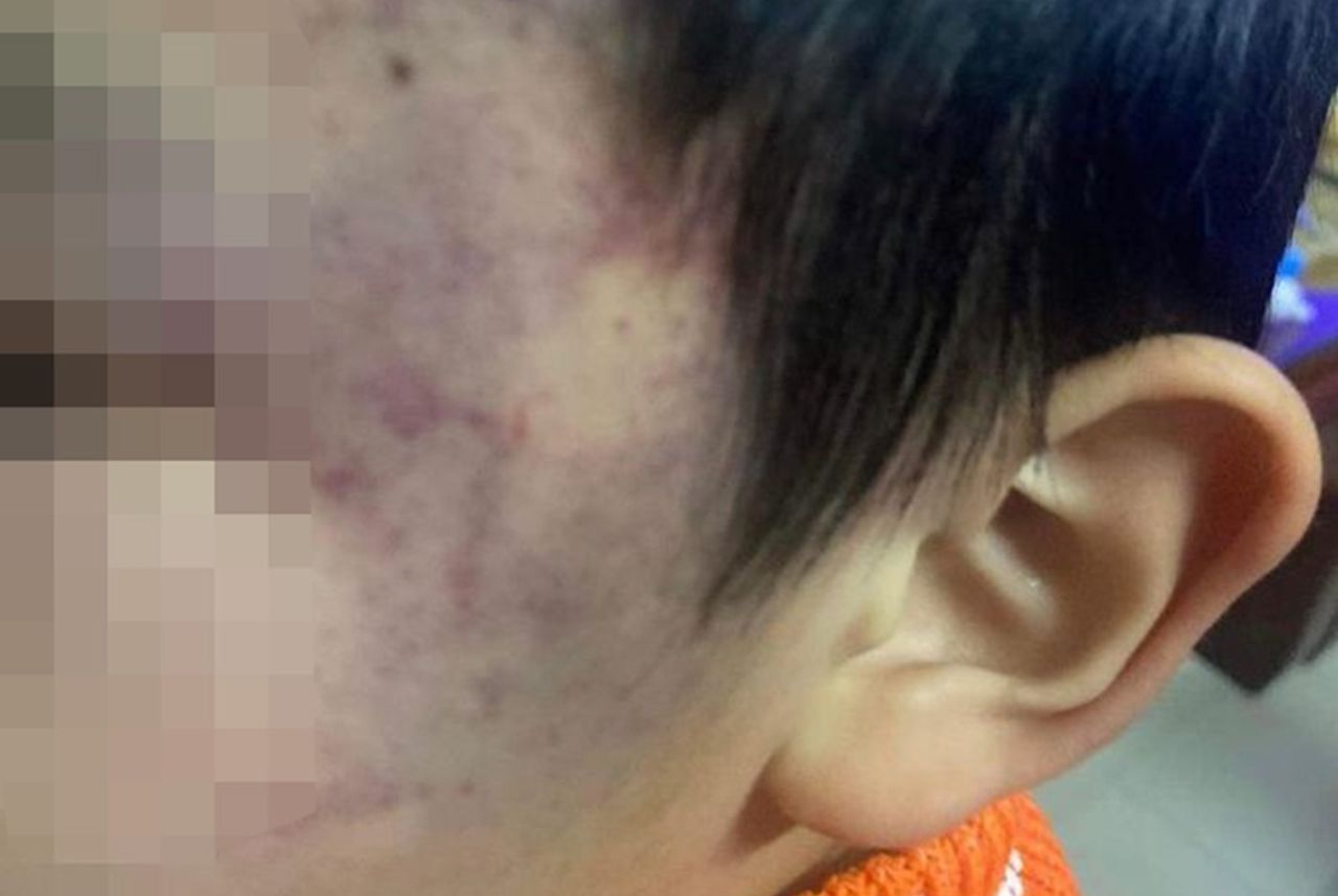 Vụ bé trai 4 tuổi bị bầm tím mặt: Công an tiết lộ bất ngờ