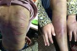 Tin trong nước - Vụ bé gái ở Hà Đông nghi bị bạo hành, xâm hại tình dục: UBND Hà Nội ra văn bản hỏa tốc