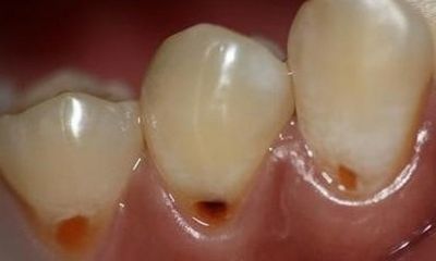 Răng hỏng gây hại đến cơ thể như thế nào?