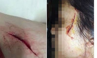 Hoang mang tin đồn cô gái bị rạch mặt ở Hà Nội