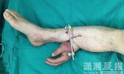 Hi hữu: Phẫu thuật nối tay vào chân