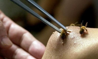 Đồng Nai: Hai bé trai nhập viện vì bị ong vò vẽ đốt hơn 100 mũi