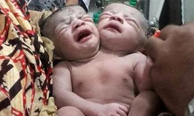 Hàng ngàn người kéo đến bệnh viện xem em bé 2 đầu ra đời