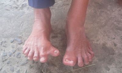Người đàn ông có nhiều ngón tay, chân nhất Việt Nam