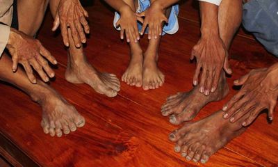  “Giải mã” gia tộc 6 đời dư ngón chân tay