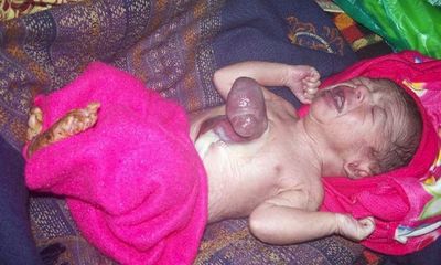 Ấn Độ: Bé sơ sinh có tim nằm ngoài lồng ngực