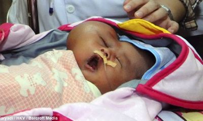  Kỳ lạ bé sơ sinh mang khuôn mặt hình trái tim