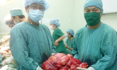 Lấy khối u nặng 11kg ra khỏi ổ bụng bệnh nhân