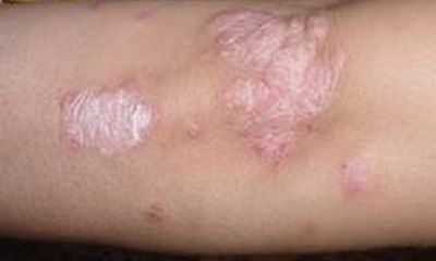 Hỏi và đáp về bệnh vẩy da