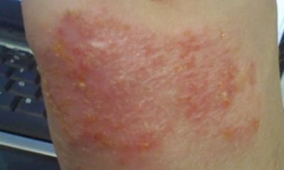 Hỏi và đáp về bệnh vẩy da
