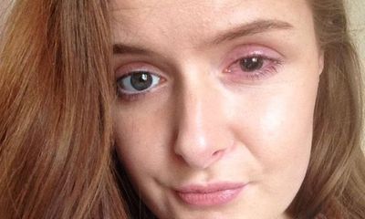 Cô gái 23 tuổi xinh đẹp suýt mù mắt vì đeo kính áp tròng sai cách