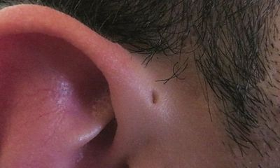 Tại sao nhiều người có lỗ nhỏ ở vành tai?